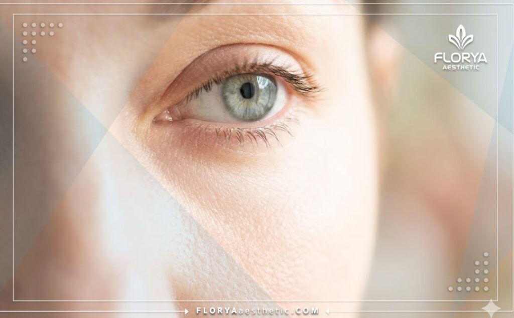 Flawless, natural-looking result of a successful under-eye procedure