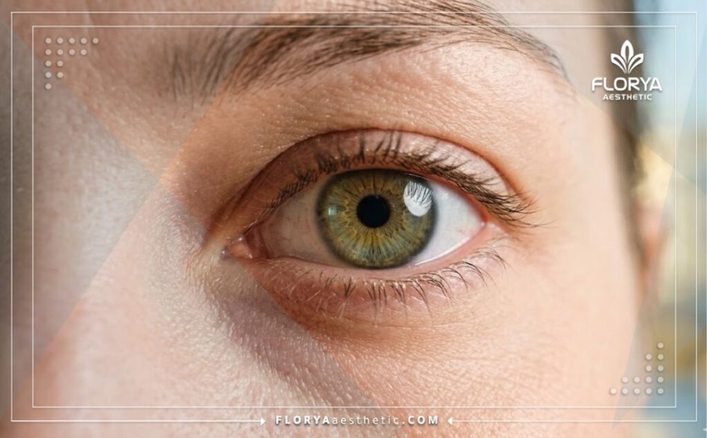 نتيجة مثالية وناجحة لاستعادة الرؤية وصحة العين بعد العلاج.