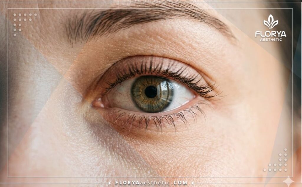 نتيجة مثالية وطبيعية جداً لتركيب عين صناعية تجميلية.