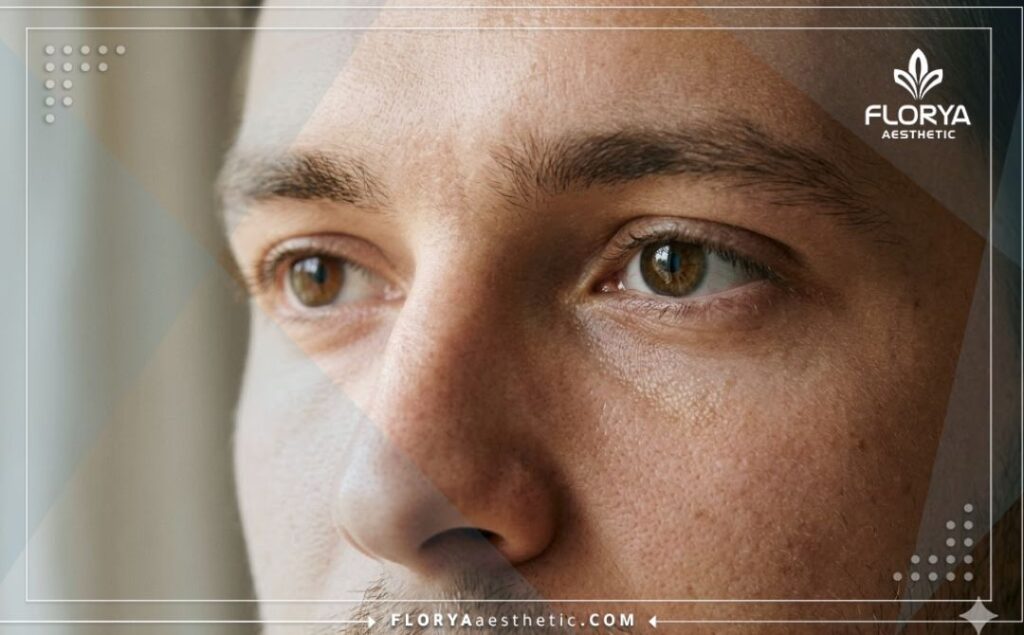 نتيجة مثالية وناجحة تظهر استقامة العينين بعد جراحة الحول.