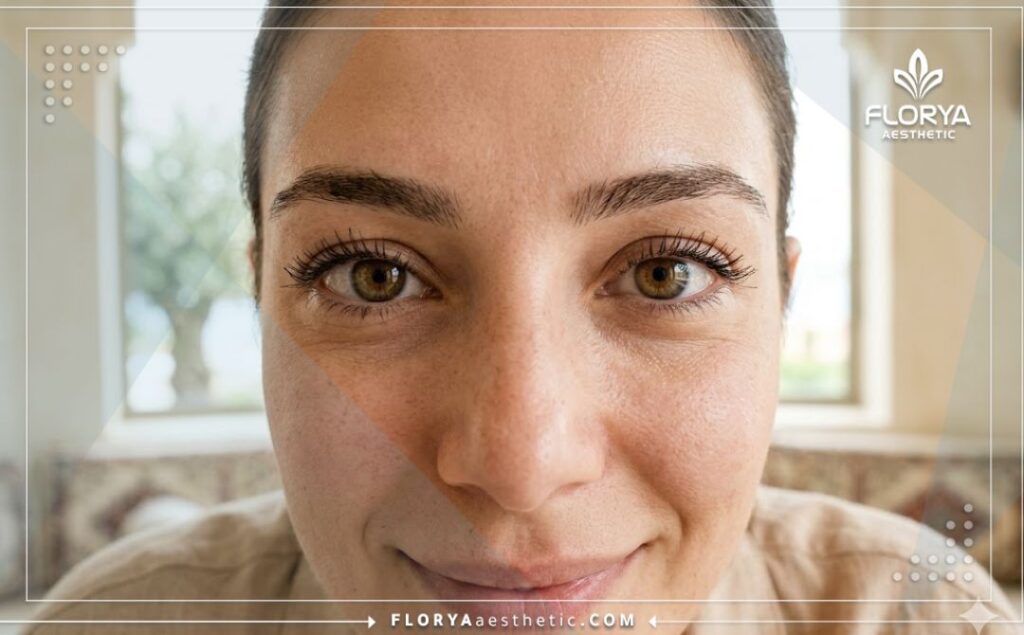 نتيجة مثالية وعيون مستقيمة تماماً بعد العلاج