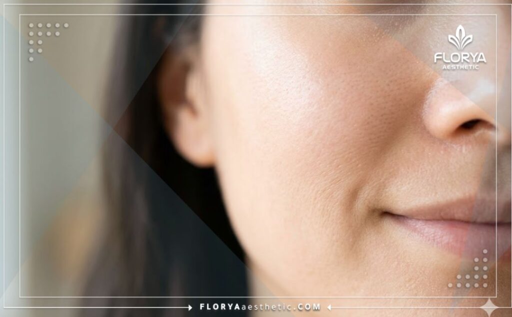 Идеально чистая кожа после удаления капилляров