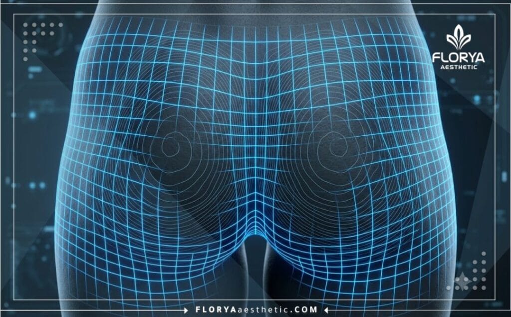 High-tech 3D surface scan analyzing the buttock anatomy for precise contouring and fat removal