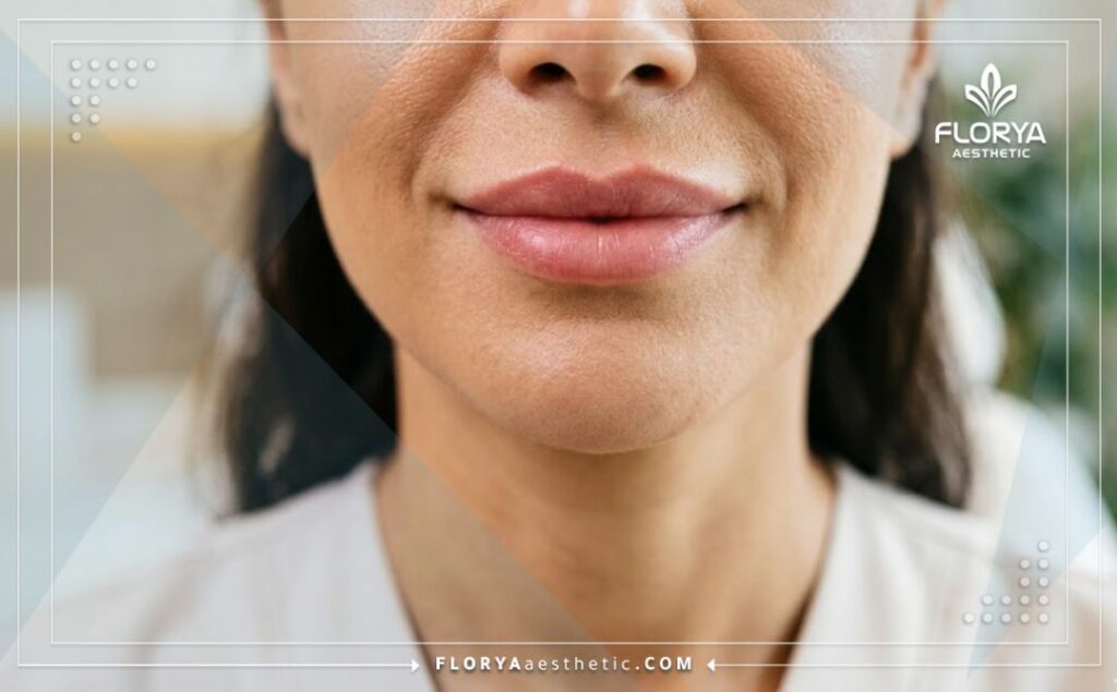 نتيجة مثالية وشفاه متناسقة بعد الخضوع لإجراء الحقن التجميلي