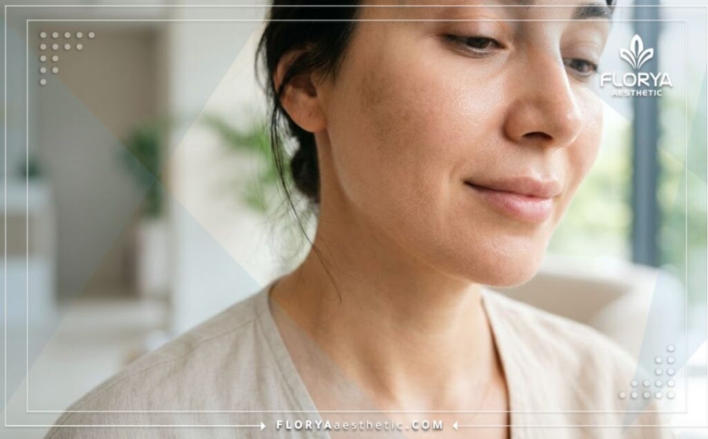 Flawless, glowing and even-toned skin result after Dermamelan treatment