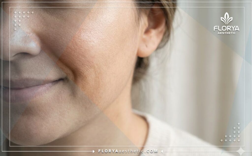Macro shot of perfect, glowing skin after a successful chemical peel.