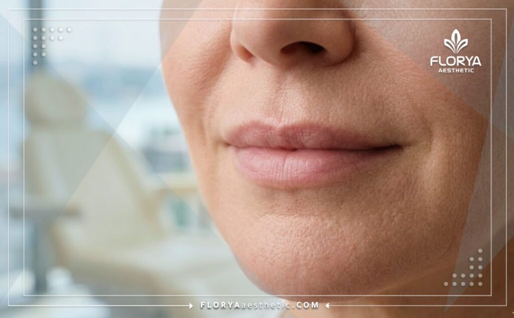 Cinematic close-up showing the smooth, flawless results around the mouth after laser therapy.