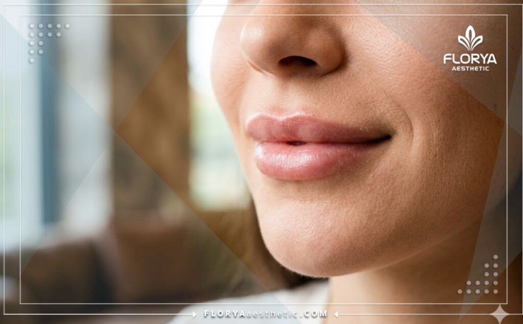 نتيجة مثالية وطبيعية لعملية تجميل وكنتور الشفاه تبرز الجمال والامتلاء