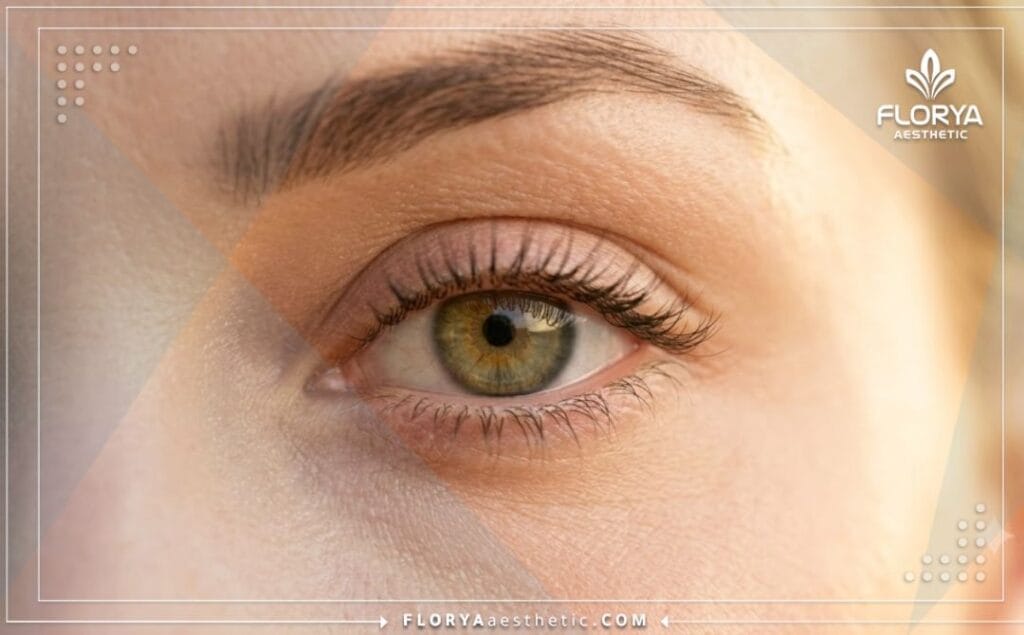 Flawless aesthetic outcome of a cat eye procedure highlighting natural beauty