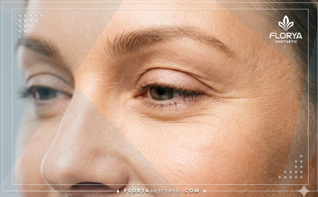 Close-up of perfect and natural results after cosmetic eyelid surgery.