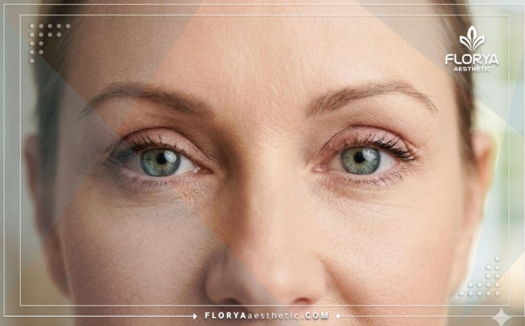 Close-up showing flawless and youthful eyes after cosmetic eyelid surgery