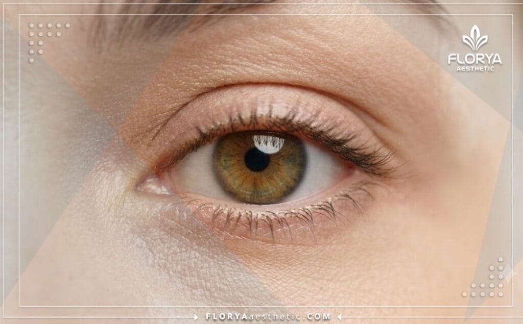 Résultat esthétique parfait et naturel mettant en valeur la beauté des yeux rajeunis.
