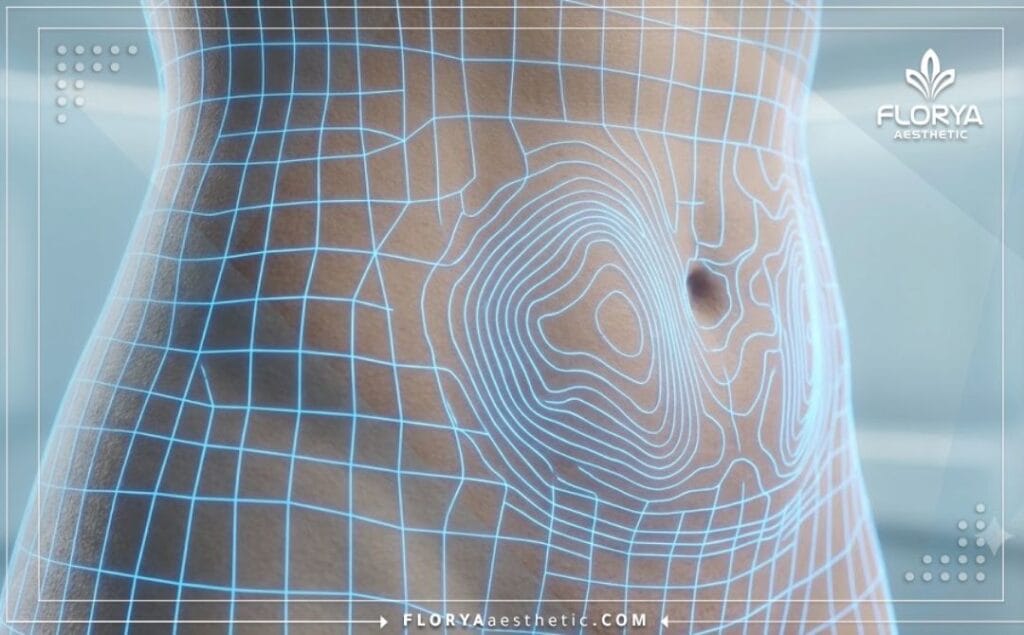 High-tech 3D digital surface scan highlighting targeted fat freezing anatomical areas.