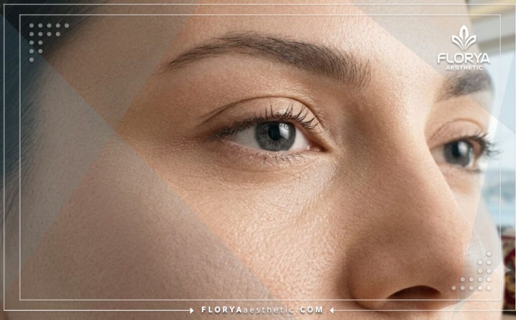 Résultat esthétique parfait et naturel d'une chirurgie du contour des yeux
