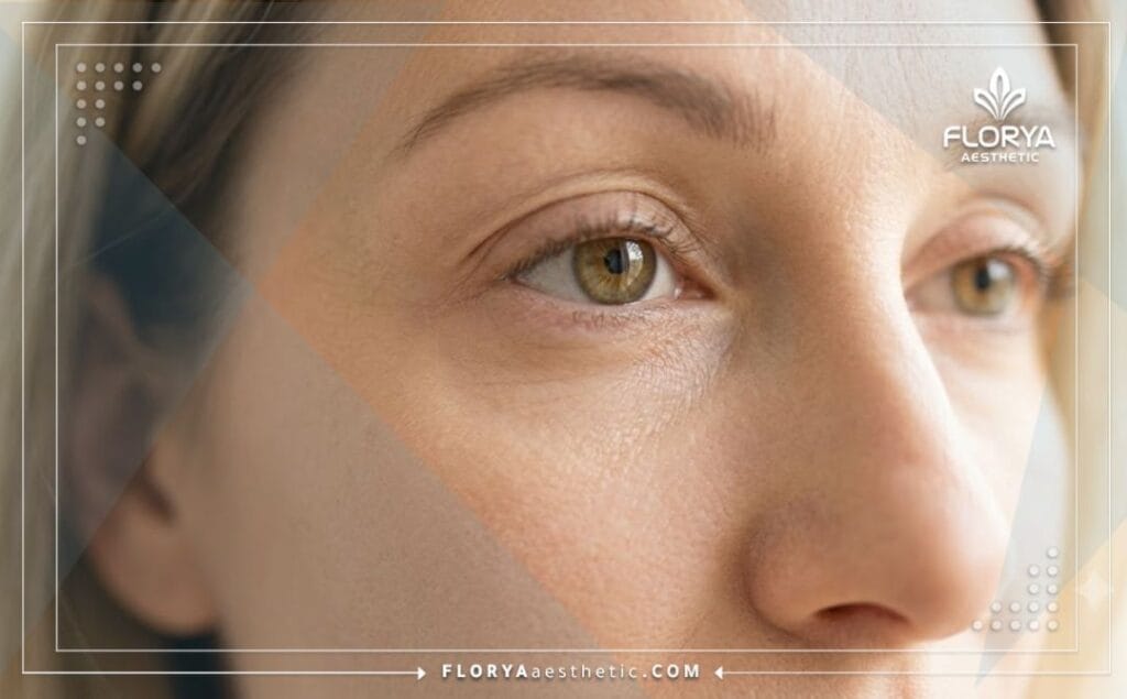 نتائج مثالية ومظهر طبيعي ناعم لمنطقة تحت العين بعد التجميل