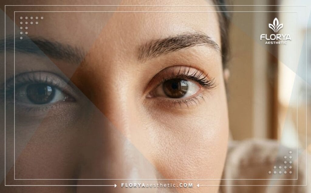 Close-up showing the flawless and natural aesthetic outcome of reconstructive eyelid surgery.