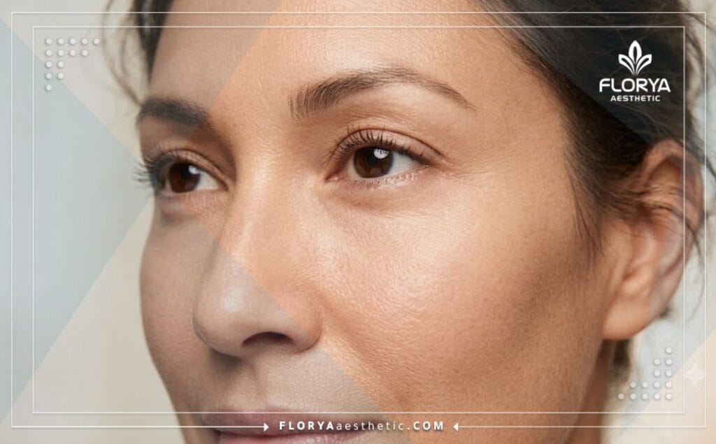 Plano cinematográfico detallado con el resultado perfecto tras el relleno de ojeras