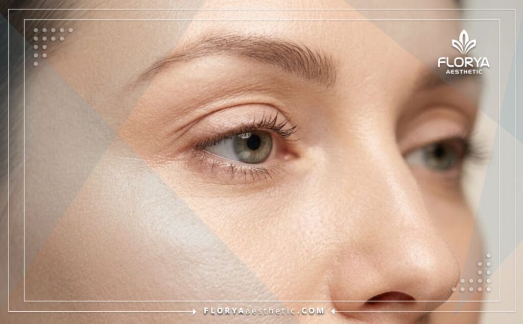 Résultat esthétique parfait et naturel après le raffermissement de la peau des yeux.