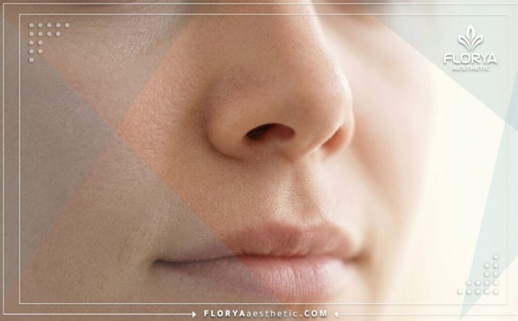 Close-up showing the flawless and symmetrical result of nostril reduction