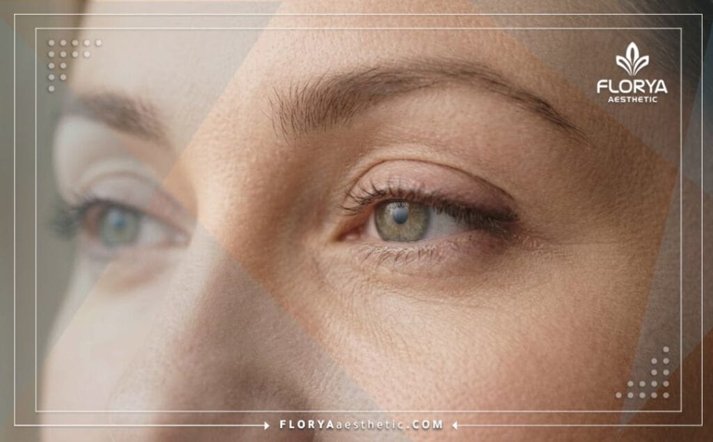 Flawless aesthetic outcome of eyelid scar treatment