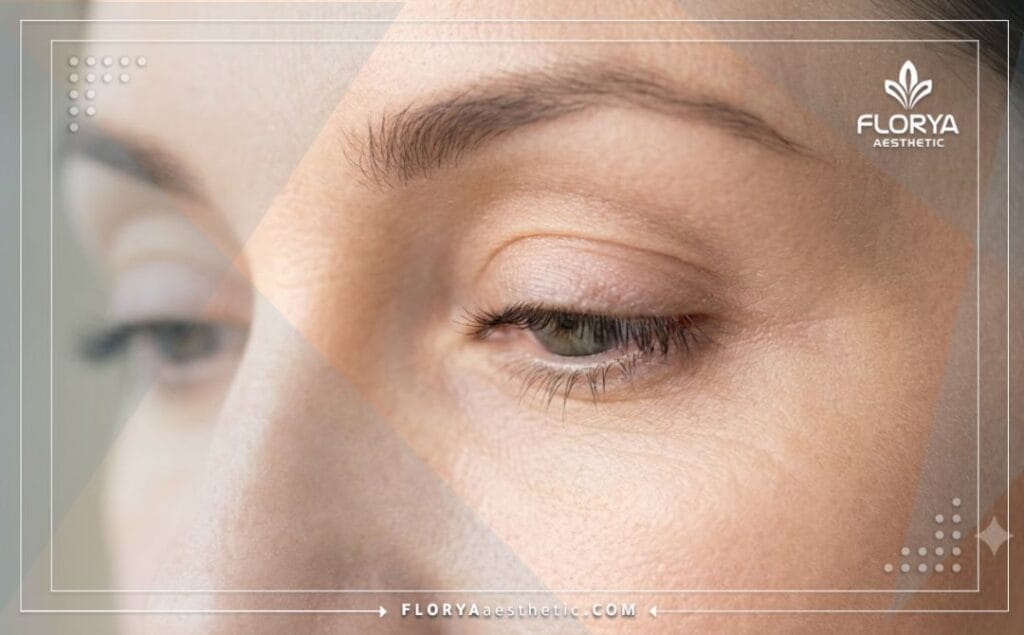 Flawless aesthetic result of the eyelid area after cosmetic enhancement.