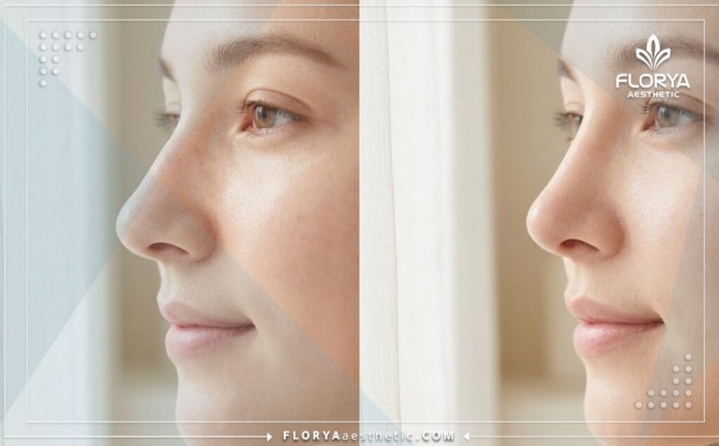 Close-up of perfect and natural results after a successful rhinoplasty procedure.